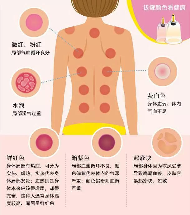 拔罐看色辨健康,一張圖秒懂身體狀況,值得收藏