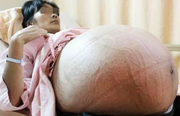 25歲產婦剖腹產子,孩子一出生30幾個父親爭相搶抱孩子,事實淚目