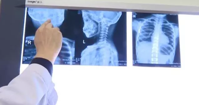 9歲男童長期玩手機,腦袋變歪難以回正!家長別再縱容孩子玩手機了,造成的傷害完全顛覆你的想像!
