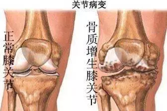 一個民間治癒率極高的「骨質增生」配方,基本上都是一副藥既愈,不再復發!