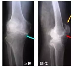 一個民間治癒率極高的「骨質增生」配方,基本上都是一副藥既愈,不再復發!