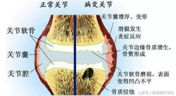 一個民間治癒率極高的「骨質增生」配方,基本上都是一副藥既愈,不再復發!
