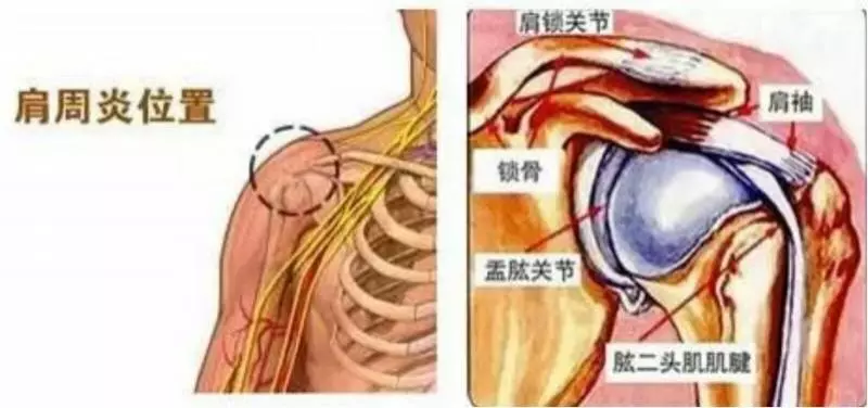 患有肩周炎,疼到晚上難以入眠,幸得一「藥方」三個月後就把肩周炎治好了!