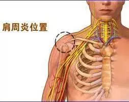 患有肩周炎,疼到晚上難以入眠,幸得一「藥方」三個月後就把肩周炎治好了!