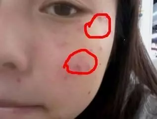 女人皮膚這樣就是有蟎蟲,很多人不知道,教你一招,去蟎蟲更健康