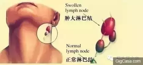 脖子有腫塊除了淋巴出問題,竟然還有其他原因!別再嚇自己了!