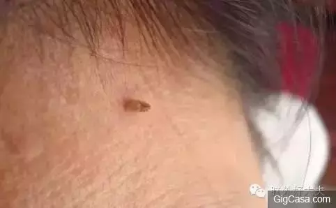脖子有腫塊除了淋巴出問題,竟然還有其他原因!別再嚇自己了!