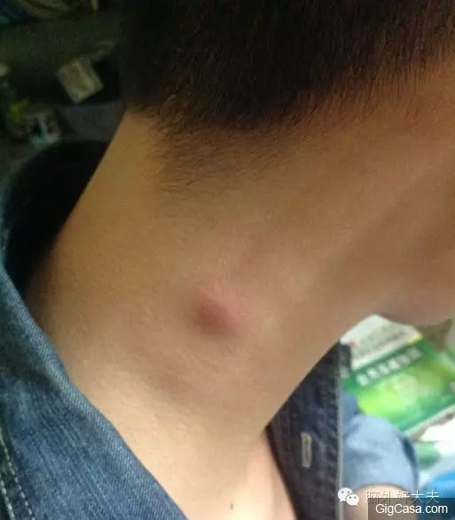 脖子有腫塊除了淋巴出問題,竟然還有其他原因!別再嚇自己了!