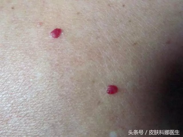 皮膚上突然長出「紅痣」,是衰老特徵,還是皮膚腫瘤?快聽聽醫生的說法!
