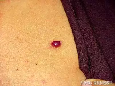皮膚上突然長出「紅痣」,是衰老特徵,還是皮膚腫瘤?快聽聽醫生的說法!