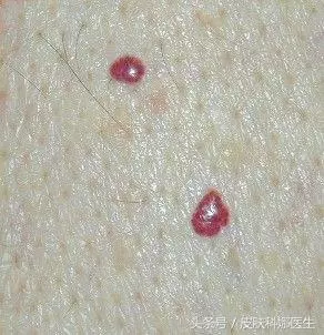 皮膚上突然長出「紅痣」,是衰老特徵,還是皮膚腫瘤?快聽聽醫生的說法!