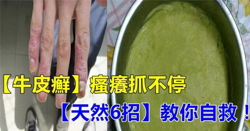 「牛皮癬」搔癢抓不停?「天然6招」鎮靜又抗炎,自救「紅斑、脫屑」必須學!