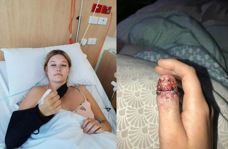 愛咬指甲竟導致絕症 女需截肢才能保命