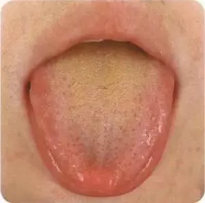 10個人脾9個虛!脾虛的6大症狀你有幾個?長期脾虛的危害是什麼?