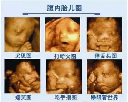 懷孕6個月做孕檢,發現胎兒唇齶裂嚴重,預防唇齶裂這兩點要做好