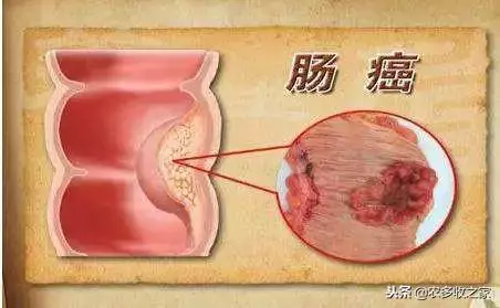 2018全球癌症年報出爐!十大致癌因素,9個你能避開!