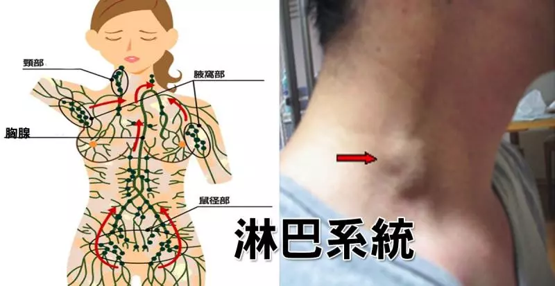 「肥胖」、「癌細胞」的幕後黑手是「淋巴堵塞」!5招「淋巴暢通法」排毒消腫「免花錢」