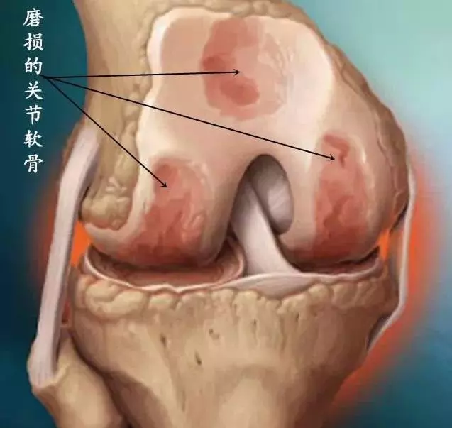 生薑+綠豆真厲害,每天吃一碗,【祛濕消炎、活血化瘀】膝蓋不疼,滑膜炎積液也拜拜了