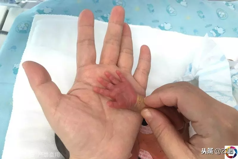 孕婦懷孕6個月在家產「掌心寶寶」,急壞家人,住保溫箱2月活下來