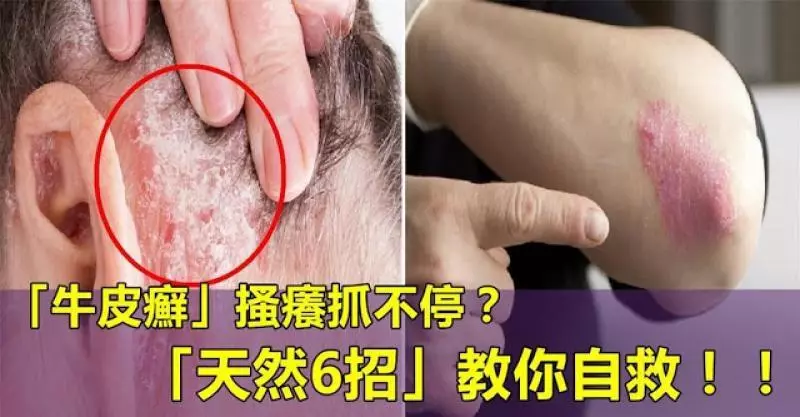 「牛皮癬」搔癢抓不停?「天然6招」鎮靜又抗炎,自救「紅斑、脫屑」必須學!