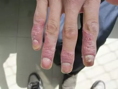 「牛皮癬」搔癢抓不停?「天然6招」鎮靜又抗炎,自救「紅斑、脫屑」必須學!