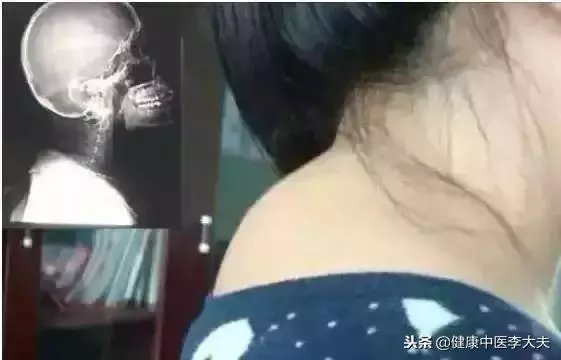 脖子後面的大椎穴,「克制」頸椎病,收藏了!