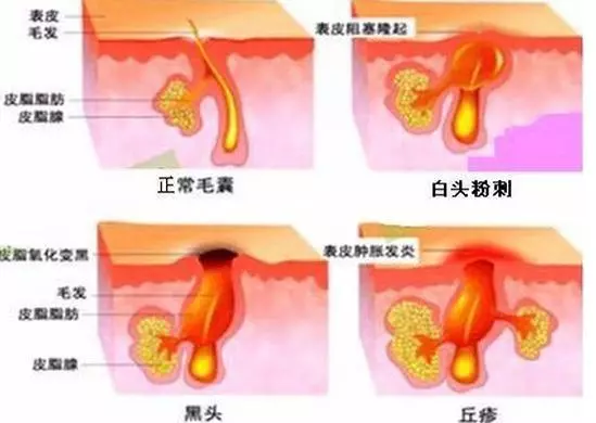 痘痘消了沒隔幾天又出現?這四種行為你是不是也經常做