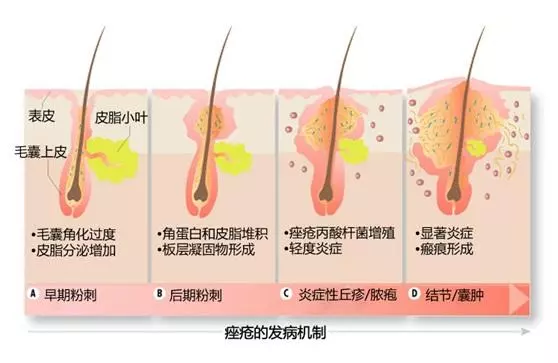 痘痘消了沒隔幾天又出現?這四種行為你是不是也經常做
