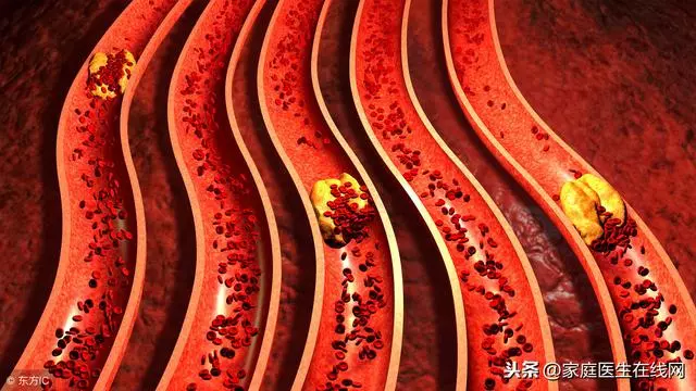 血管堵塞時,會頻頻發出這7個「警告」,要重視起來