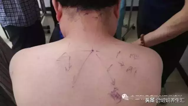 中醫治療頸椎病大全,全是乾貨!