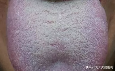 中醫舌診精煉總結!從舌頭看身體,一清二楚(建議收藏)