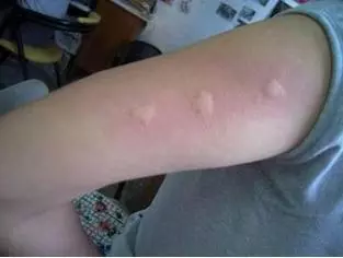 被蚊子咬了又癢又難受!教你簡單一招,不用藥,1分鐘快速止癢!