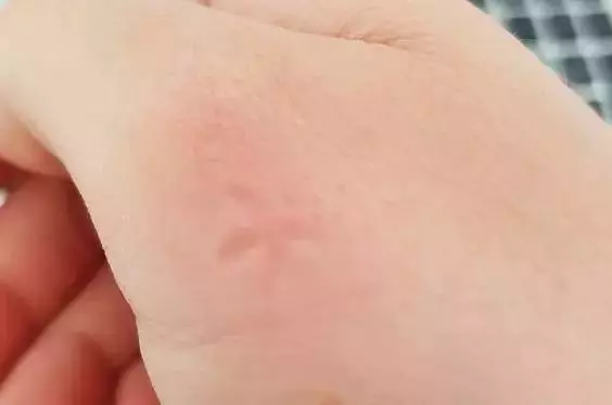被蚊子咬了又癢又難受!教你簡單一招,不用藥,1分鐘快速止癢!