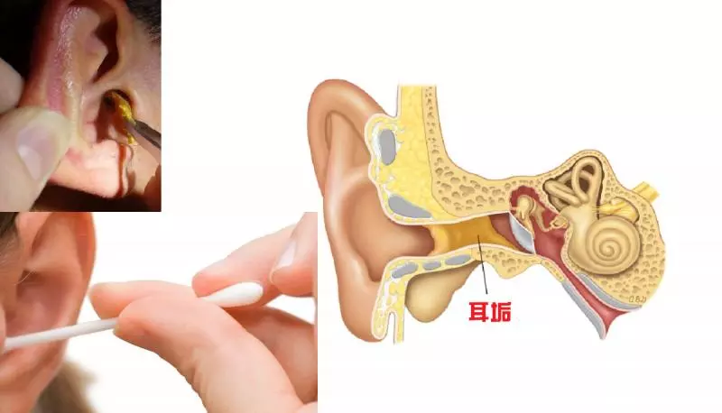 「耳鼻喉科」教授告訴你:「耳垢」不是垢!三要訣:別掏、別挖、別清理!
