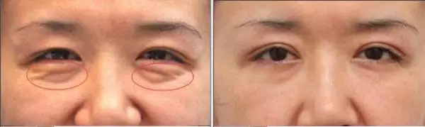 好神奇!三分鐘後眼袋 、魚尾紋全消失了!居然只要在水裡加入(這個東西)