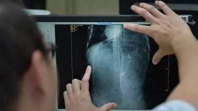 四十二歲年輕夫妻患上肝癌相繼去世,醫生:被這種食物害慘了