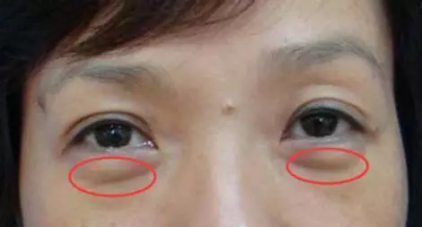 女人有眼袋愛打玻尿酸?別傻了!塗點廚房便宜貨,兩周撫平眼袋
