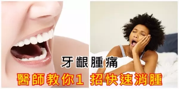 牙齦腫痛,牙醫教你1招快速消腫!