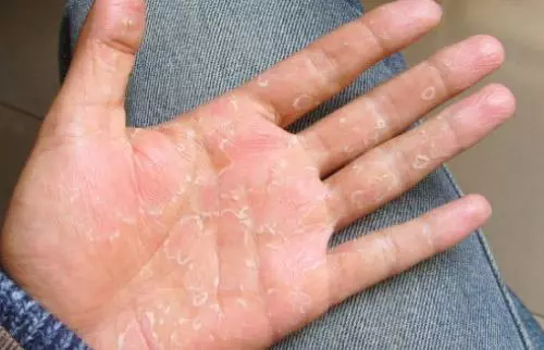 濕疹為什麼一直不見好轉,簡單方法讓你輕鬆治