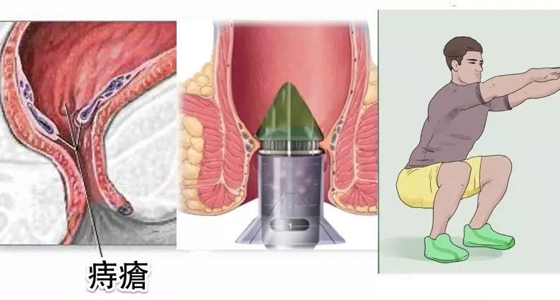太好了,痔瘡終於有解了!教你三種方法自然消除,人人都能不再癢!只要這樣做...簡簡單單!!