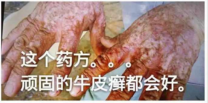 難得一見【治皮膚奇癢很有效的土方】一定要收藏