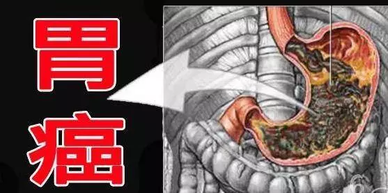出現這5個症狀立刻去查胃別遲疑,胃癌可能快來了!