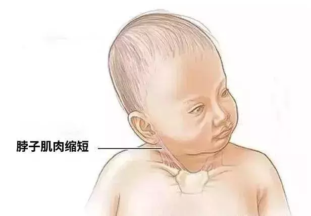 只因為抱姿不對,她讓寶寶成了斜頸