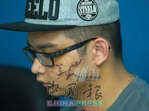 因為嘴癢惹怒對方!一句話換來毒打!青年臉縫了至少100針險!對方要求和解遭拒!誓要討回公道!