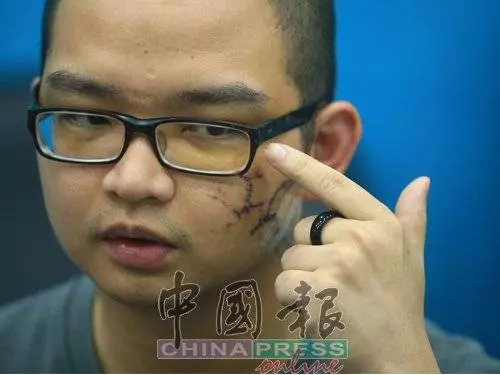 因為嘴癢惹怒對方!一句話換來毒打!青年臉縫了至少100針險!對方要求和解遭拒!誓要討回公道!
