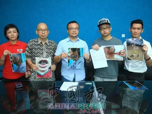 因為嘴癢惹怒對方!一句話換來毒打!青年臉縫了至少100針險!對方要求和解遭拒!誓要討回公道!