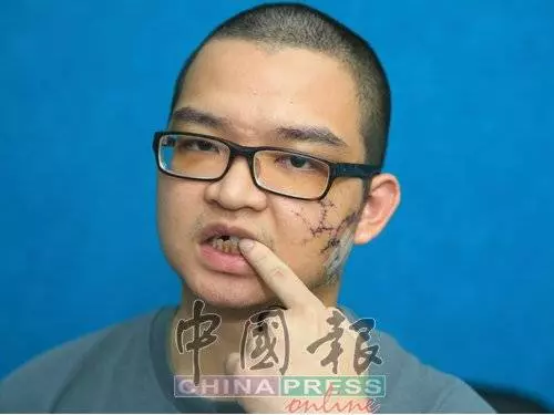 因為嘴癢惹怒對方!一句話換來毒打!青年臉縫了至少100針險!對方要求和解遭拒!誓要討回公道!