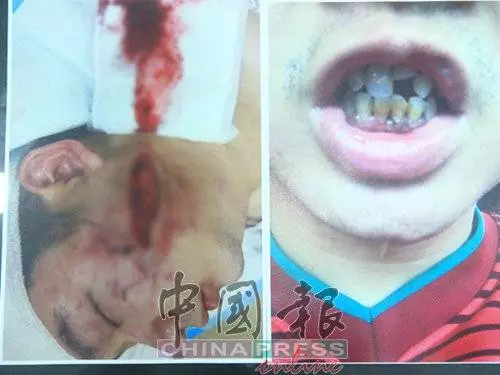 因為嘴癢惹怒對方!一句話換來毒打!青年臉縫了至少100針險!對方要求和解遭拒!誓要討回公道!