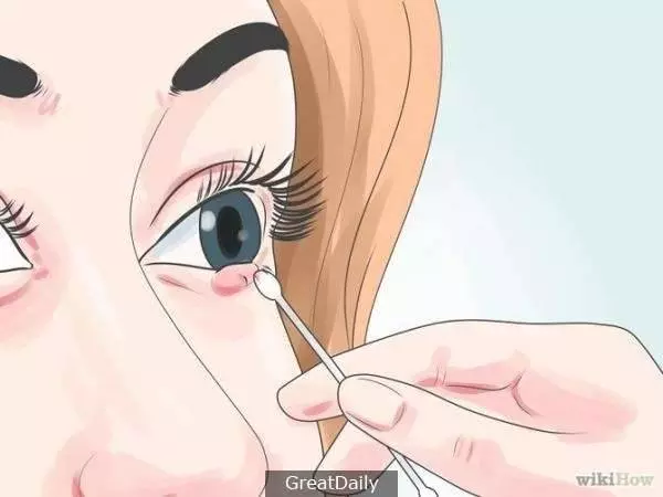 三種方法快速消除「針眼」!這篇收藏好!!