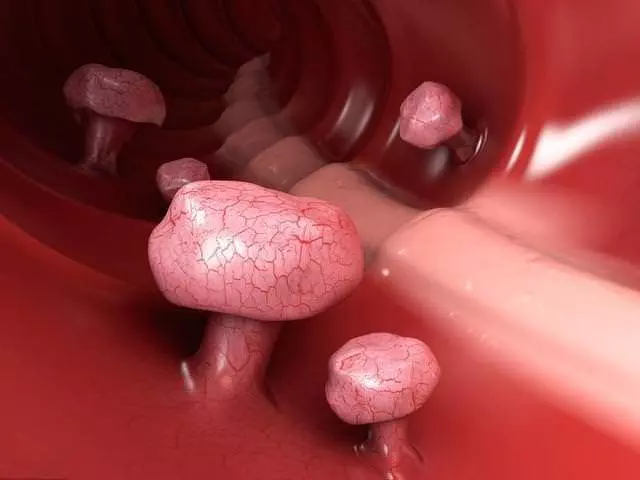 大腸病變的人越來越多,謹記:身體出現【3多2痛】,趕緊去醫院檢查,能保命!